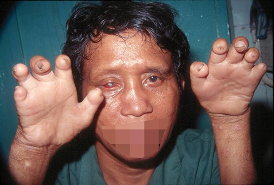 fotos de lepra (14)_thumb[1].jpg